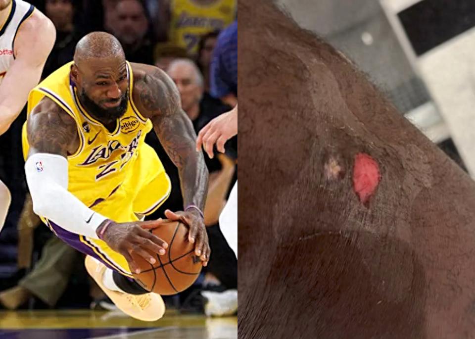 Châm biếm việc cứu bóng năm nay đã kết thúc! James khoe vết thương và kêu đau, chúc mừng Doncic được chọn là cầu thủ xuất sắc nhất tuần