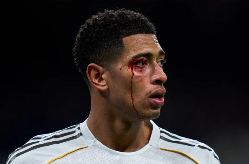 Jude Bellingham rách mắt, vẫn bị trọng tài phạt thẻ vàng